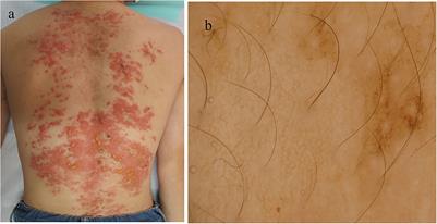 Prurigo pigmentosa clinically and immunologically mimicking autoimmune bullous disease: A case report